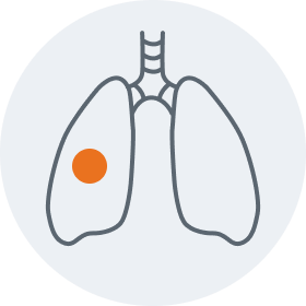 Lung (non-small cell) graphic