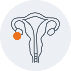 Ovarian graphic